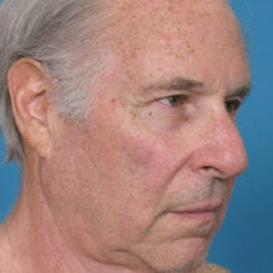 02before-face-lift-dr-daniel-man-jfside1-jpg