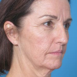 02before-face-lift-dr-daniel-man-kiabside1-jpg