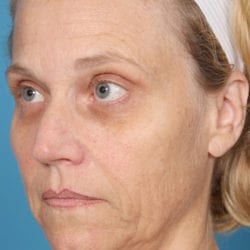 02before-face-lift-dr-daniel-man-kielside1-jpg