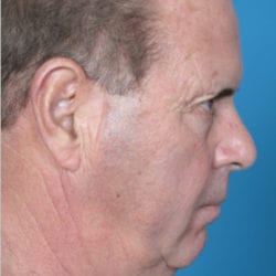 02before-face-lift-dr-daniel-man-mfside-jpg