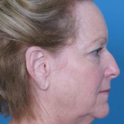 02before-face-lift-dr-daniel-man-ssside1-jpg