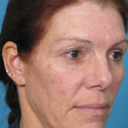 02before-forehead-lift-dr-daniel-man-sumeside1-jpg