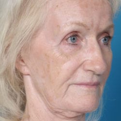 02before-hbside1-jpg