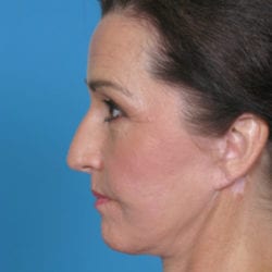 03after-eco-laser-dr-daniel-man-kabside3-jpg