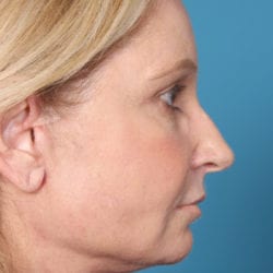 03after-angrside2-jpg