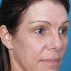 03after-eyelid-lift-dr-daniel-man-sumeside1-jpg