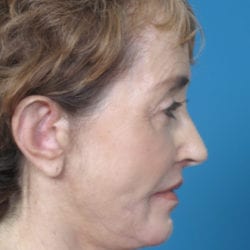 03after-face-lift-dr-daniel-man-elboside3-jpg