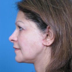 03after-face-lift-dr-daniel-man-elside2-jpg