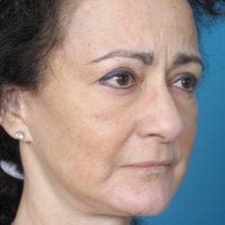 03after-face-lift-dr-daniel-man-fpside2-jpg