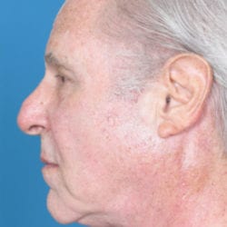 03after-face-lift-dr-daniel-man-jfside2-jpg