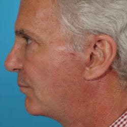 03after-face-lift-dr-daniel-man-jfside3-jpg