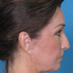 03after-face-lift-dr-daniel-man-kiabside2-jpg