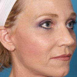 03after-face-lift-dr-daniel-man-kielside2-jpg