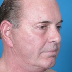 03after-face-lift-dr-daniel-man-mfside1-jpg