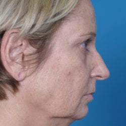 03before-angrside2-jpg