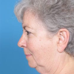 03before-face-lift-dr-daniel-man-cdside3-jpg