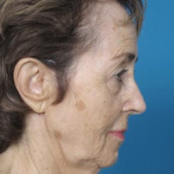 03before-face-lift-dr-daniel-man-elboside3-jpg