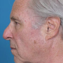 03before-face-lift-dr-daniel-man-jfside2-jpg