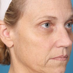 03before-face-lift-dr-daniel-man-kielside2-jpg