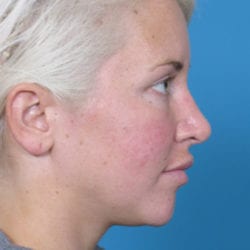 03before-face-lift-dr-daniel-man-rwside2-jpg