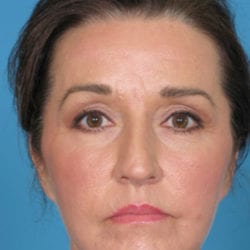 04after-eco-laser-dr-daniel-man-kafront1-jpg