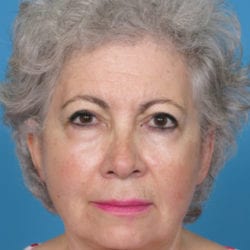 04after-face-lift-dr-daniel-man-cdside4-jpg