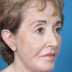 04after-face-lift-dr-daniel-man-elboside4-jpg