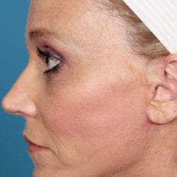 04after-face-lift-dr-daniel-man-kielside3-jpg