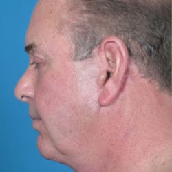 04after-face-lift-dr-daniel-man-mfside2-jpg