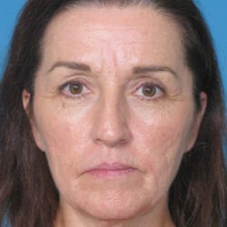 04before-eco-laser-dr-daniel-man-kafront1-jpg