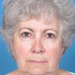 04before-face-lift-dr-daniel-man-cdside4-jpg