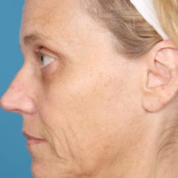 04before-face-lift-dr-daniel-man-kielside3-jpg