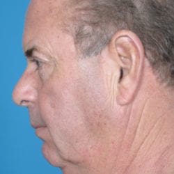 04before-face-lift-dr-daniel-man-mfside2-jpg