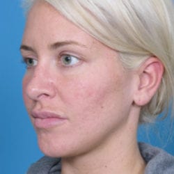 04before-face-lift-dr-daniel-man-rwside3-jpg