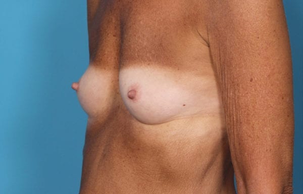 04before-locoside3-jpg