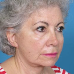 05after-face-lift-dr-daniel-man-cdside5-jpg