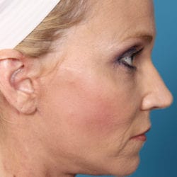 05after-face-lift-dr-daniel-man-kielside4-jpg