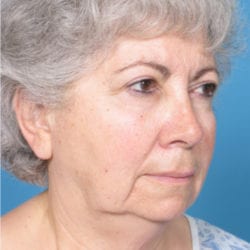 05before-face-lift-dr-daniel-man-cdside5-jpg