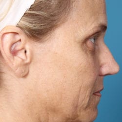 05before-face-lift-dr-daniel-man-kielside4-jpg