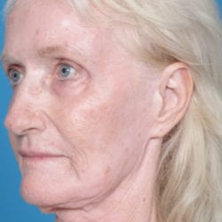 05before-hbside4-jpg