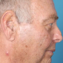 06before-face-lift-dr-daniel-man-jmside3-jpg