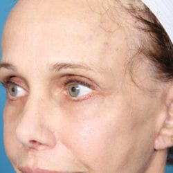 07after-face-lift-dr-daniel-man-doplside1-jpg