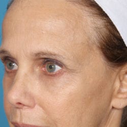 07before-face-lift-dr-daniel-man-doplside1-jpg