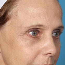 09before-face-lift-dr-daniel-man-doplside3-jpg