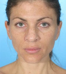 1before-25-223x300-2-jpg