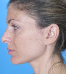 2before-19-223x300-1-jpg