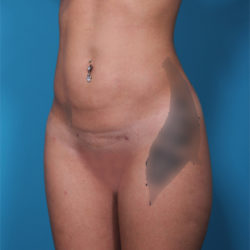 after-lipo-jpg