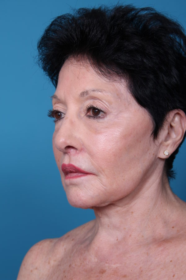 bdafterleft-jpeg-jpg