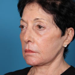 bdbeforeleft-jpeg-jpg