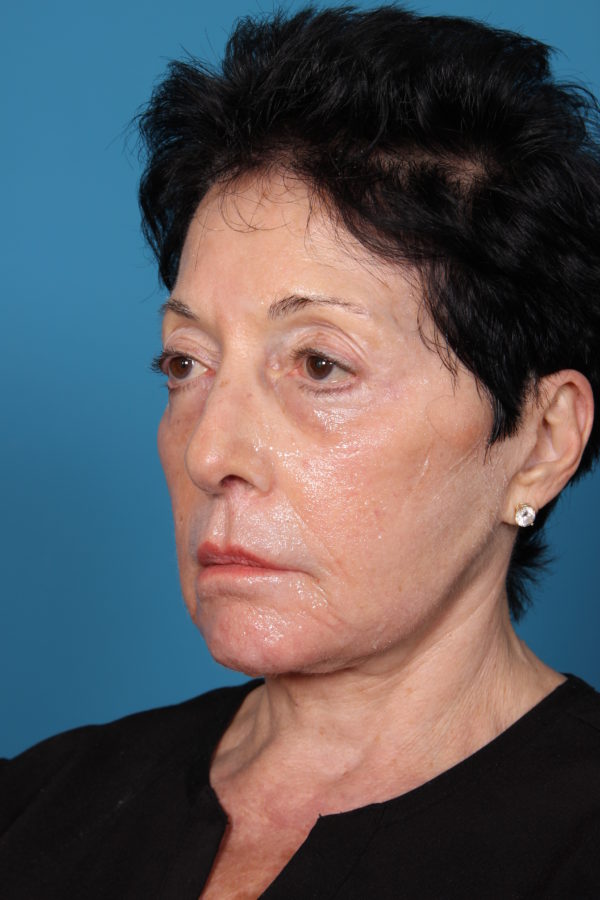 bdbeforeleft-jpeg-jpg